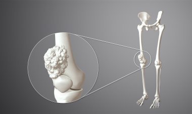 Best Bone Cancer  Treatment Hospitals in  Bangalore